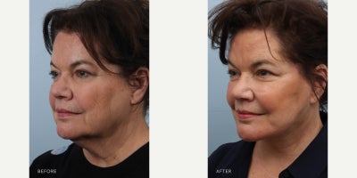 Deep Plane Facelift before and after photo