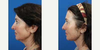 FaceTite before and after photo