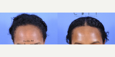 Forehead Reduction before and after photo