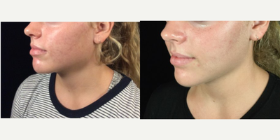 Fractional Laser before and after photo