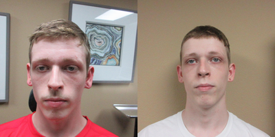 Juvederm before and after photo
