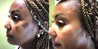Laser Resurfacing before and after photo
