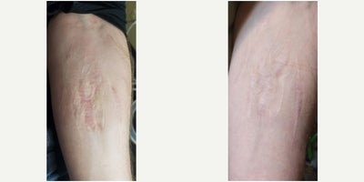 Skin Rejuvenation before and after photo