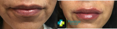 Volbella before and after photo