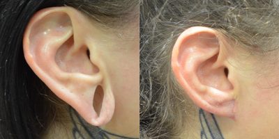 Ear Surgery before and after photo