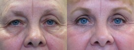 Eyelid Surgery before and after photo