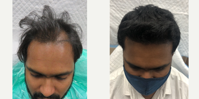 Hair Transplant before and after photo