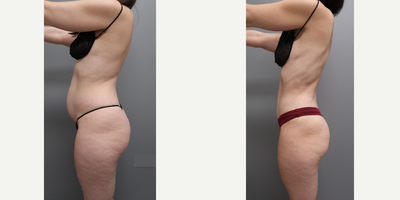 Liposuction before and after photo