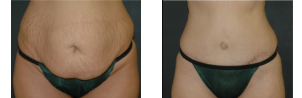 Tummy Tuck before and after photo