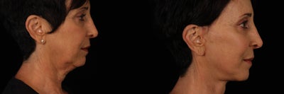 Facelift before and after photo