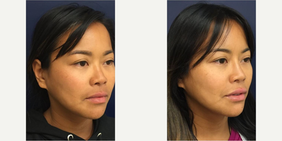 Lip Fillers before and after photo