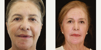 Nonsurgical Facelift before and after photo