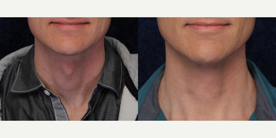 Adam's Apple Reduction before and after photo