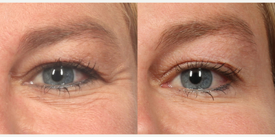 Botox before and after photo