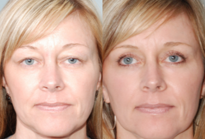 Fraxel Laser before and after photo