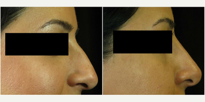 Juvederm before and after photo
