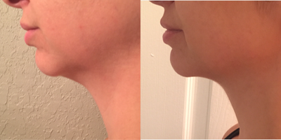 Kybella before and after photo