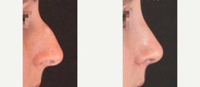 Rhinoplasty before and after photo