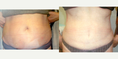 Tummy Tuck before and after photo