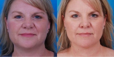 Chin Liposuction before and after photo