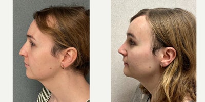 Genioplasty before and after photo