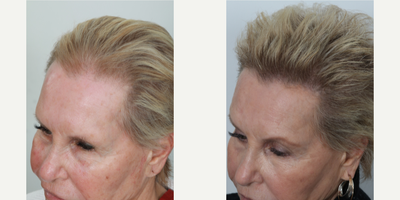 Hair Transplant before and after photo