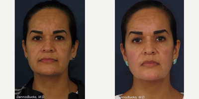 Laser Resurfacing before and after photo