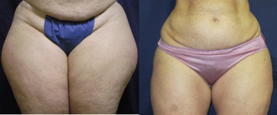 Liposuction before and after photo