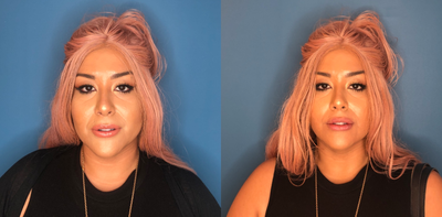 Dermal Fillers before and after photo