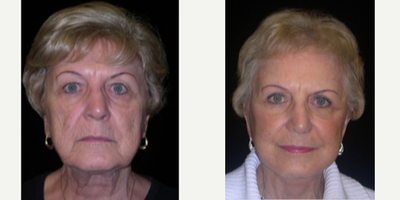Facelift before and after photo