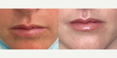 Lip Fillers before and after photo