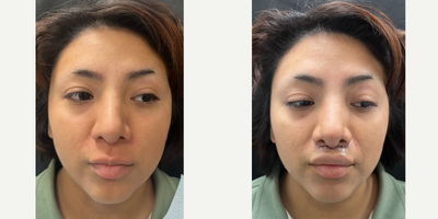 Lip Lift before and after photo