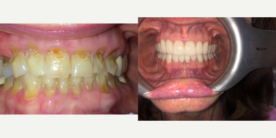 Lumineers before and after photo