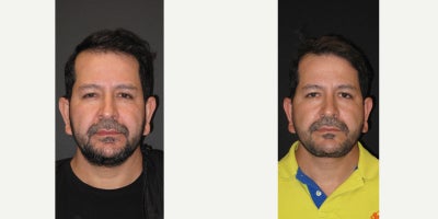 Deep Plane Facelift before and after photo