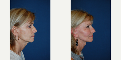 Facelift before and after photo