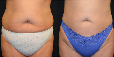 Liposuction before and after photo