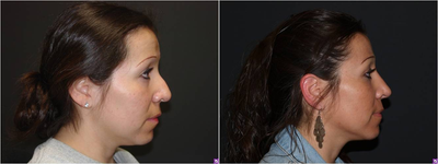 Rhinoplasty before and after photo