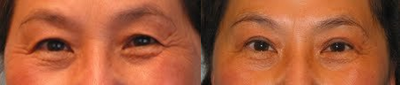 Double Eyelid Surgery before and after photo