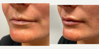 Lip Fillers before and after photo