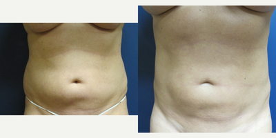Liposuction before and after photo