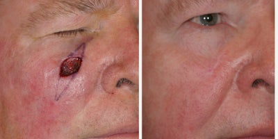 Mohs Surgery before and after photo