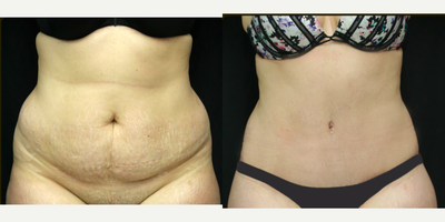 Tummy Tuck before and after photo