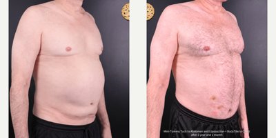 Tummy Tuck before and after photo