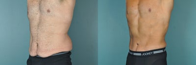 Body Lift before and after photo