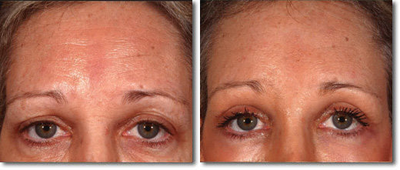 Brow Lift before and after photo