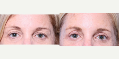 Eyelid Surgery before and after photo