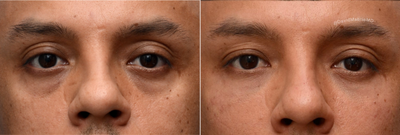 Eyelid Surgery before and after photo