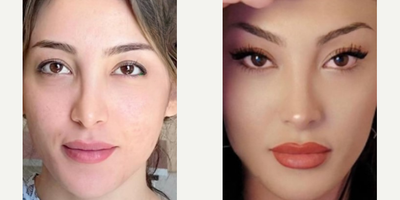 Facelift before and after photo