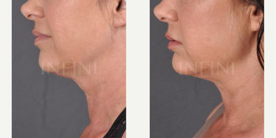 Skin Tightening before and after photo