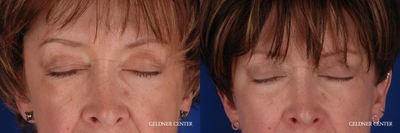 Eyelid Surgery before and after photo